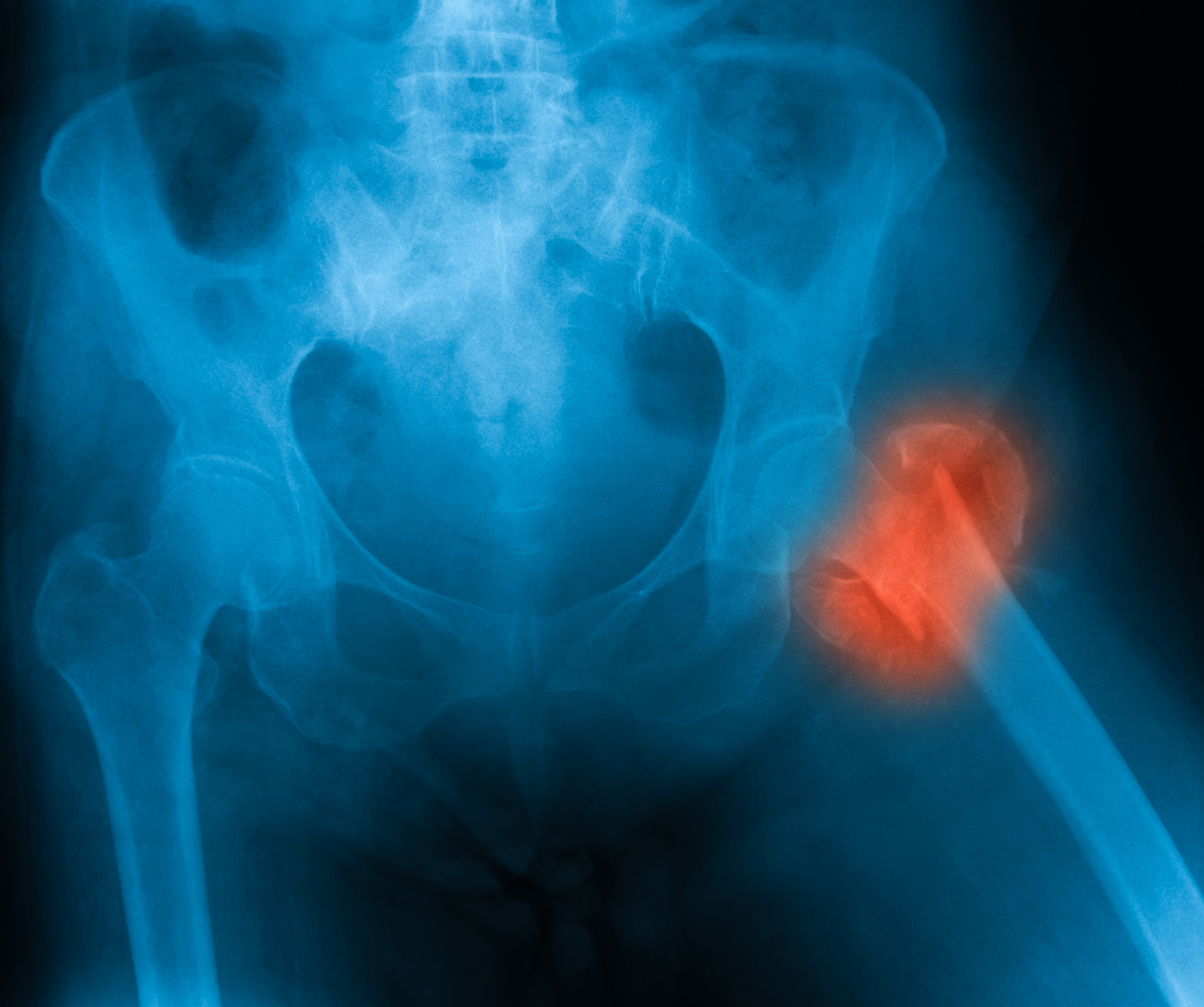 X-ray of broken hip