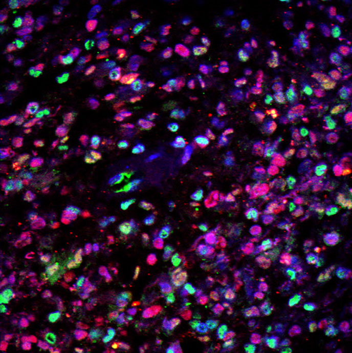 Glioblastoma under microscope with dyes