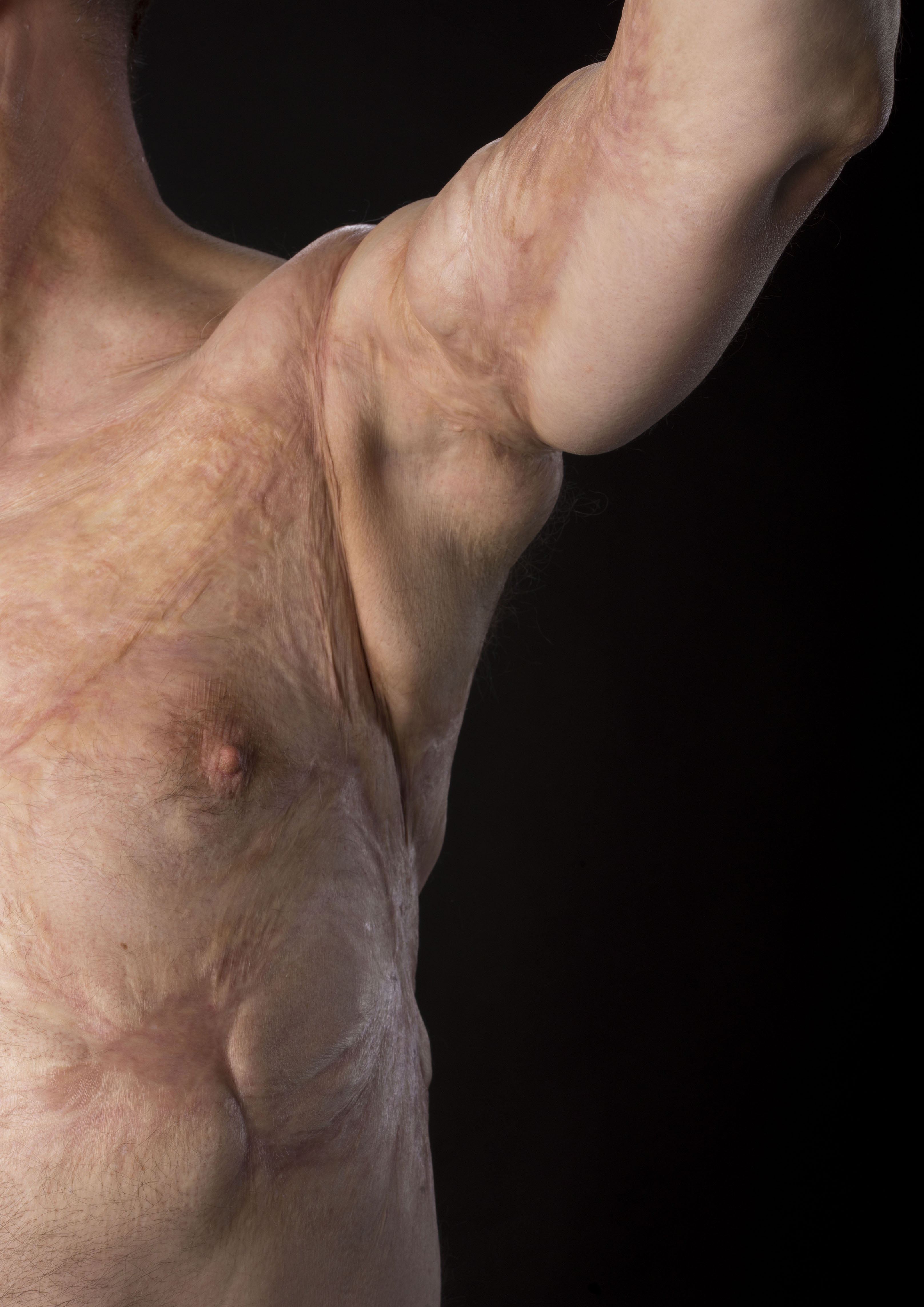 Lorna Evans: Silver Award for burn scarring